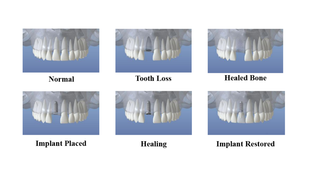 Stages of dental implant treatment, from normal teeth to tooth loss, healed bone, implant placement, healing, and restored implant.