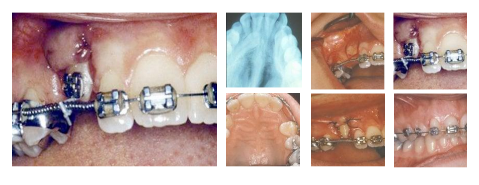 Orthodontic treatment with braces and surgical exposure to guide impacted teeth into place.
