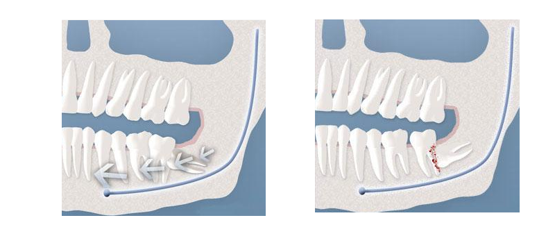 Illustration of impacted wisdom tooth pushing against other teeth and being surgically removed.